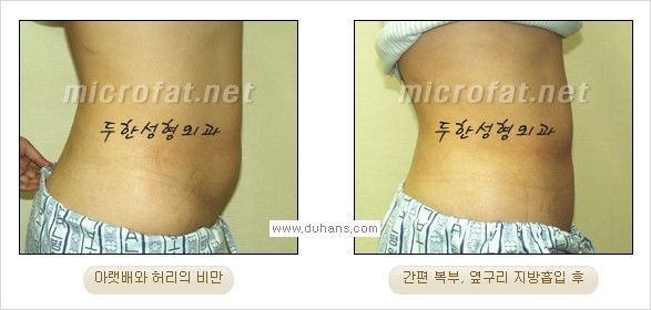 [두한성형외과 경쟁력 지방흡입] - [초음파 지방흡입과 미세흡입관을 이용한 간편지방흡입] 관련 이미지 6