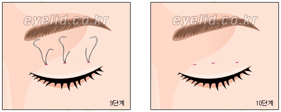 [Double Eyelid Surgery Duhan Plastic Surgery] - [Buried Method, Incision Method, Partial Incision Method] image 25
