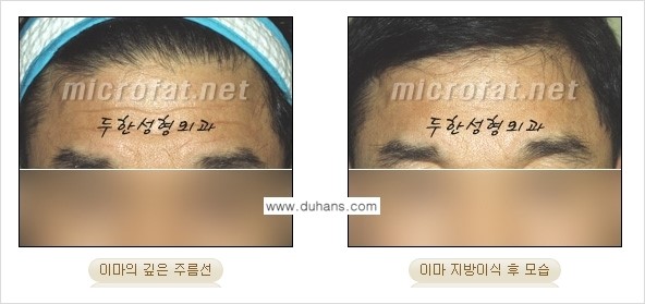 [두한성형외과의 경쟁력 있는 지방이식] - [이마 미세지방이식 2.] 관련 이미지 11