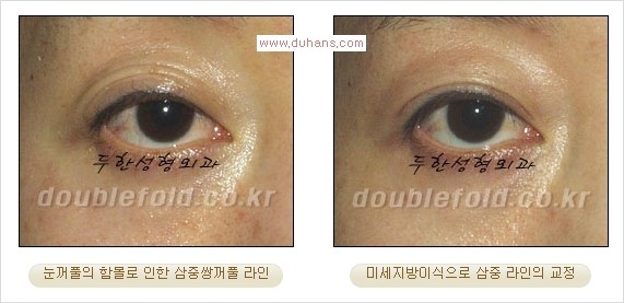 [두한성형외과 경쟁력 쌍꺼풀 재수술] - [삼중(세겹) 쌍꺼풀 라인, 눈꺼풀이 함몰된 삼중(세겹) 쌍꺼풀 라인 교정] 관련 이미지 17