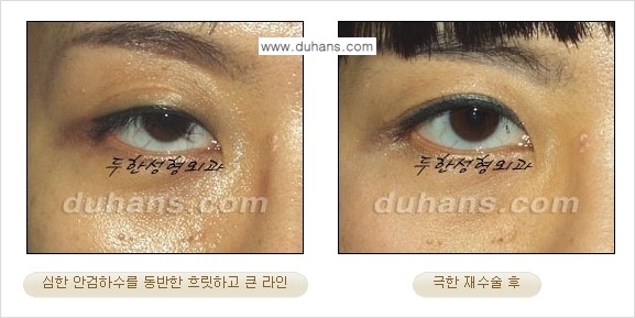 [두한성형외과 경쟁력 눈성형] - [두꺼운 라인을 교정하는 극한 눈 재수술 2.] 관련 이미지 8