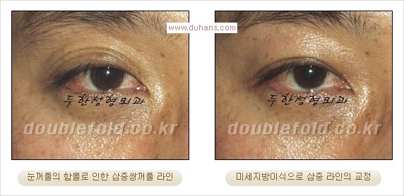 [두한성형외과 경쟁력 쌍꺼풀 재수술] - [삼중(세겹) 쌍꺼풀 라인, 눈꺼풀이 함몰된 삼중(세겹) 쌍꺼풀 라인 교정] 관련 이미지 15