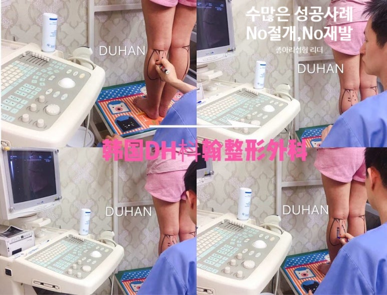 [Duhan Plastic Surgery Clinic Calf Contouring] - [Calf Reduction] image 25