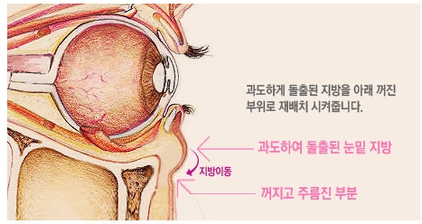 두한성형외과 눈밑성형 - 눈밑지방제거, 눈밑주름, 눈밑지방재배치 관련 이미지 97
