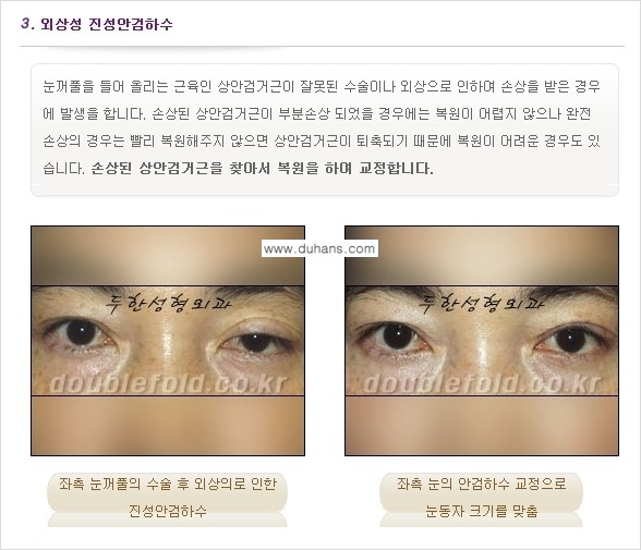 [두한성형외과 경쟁력 눈성형] - [안검하수(졸린 눈매) 재수술 안내 ①] 관련 이미지 6