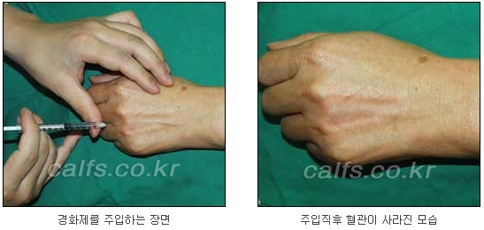 두한성형외과 보기싫은 혈관제거 - 눈밑혈관, 손과 팔의 혈관확장증 치료 관련 이미지 26