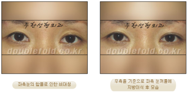 [Duhan Plastic Surgery Eye Surgery] - [Asymmetric Line, Eyelash Eversion, Deep Fixation] image 18