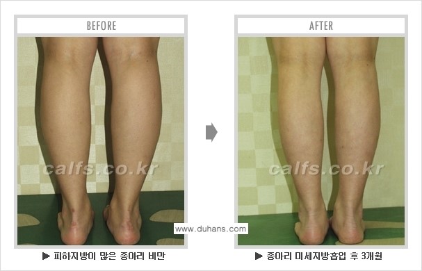 [두한성형외과 매력적인 종아리 만들기!] - [정교한 흡입 - 미세흡입관 지방흡입술 3.] 관련 이미지 8