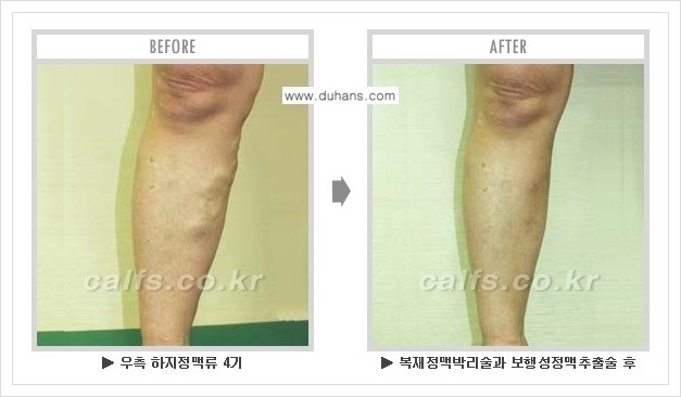 [두한성형외과 경쟁력 정맥류 치료] - [하지정맥류 사진 자료 안내 1.] 관련 이미지 14