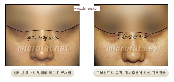 [두한성형외과 경쟁력 눈밑성형 리더] - [윗눈꺼풀 지방제거, 눈밑지방제거, 눈밑지방재배치, 눈밑지방이식 안내] 관련 이미지 11
