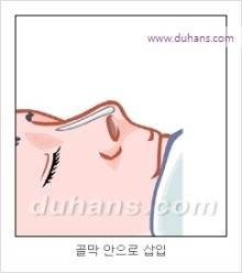 [두한성형외과 경쟁력 코성형 리더] - [자연스럽고 오똑한 콧망울! 코성형 방법]​ 관련 이미지 9