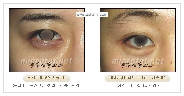 [두한성형외과 경쟁력 눈밑성형] - [눈밑 다크써클과 눈밑 애교살과의 관계] 관련 이미지 14
