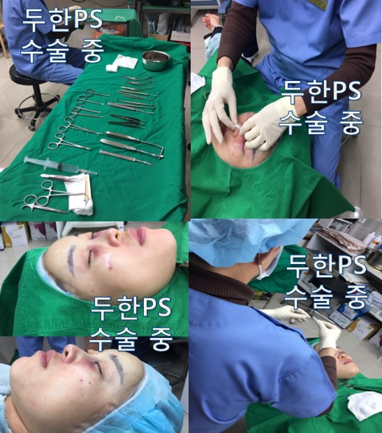 (눈밑지방이식&코 비개방 실리콘 삽입술)]-#낮은코 개선, 다크서클 개선 관련 이미지 2