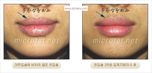 ​​[두한성형외과 경쟁력 미세지방이식] - [볼륨감 있는 입술성형] 관련 이미지 21