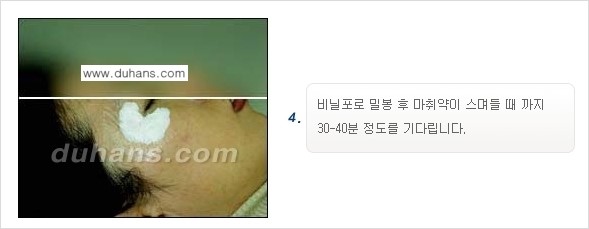 [두한성형외과 젊어지는 주름교정술] - [주름제거 시술방법 ④] 관련 이미지 7