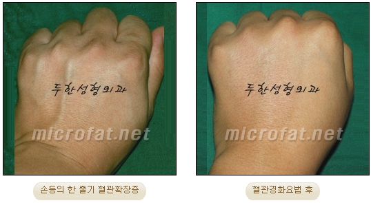 [Duhan Plastic Surgery Clinic Varicose Veins] - [Hand and Arm Venous Dilation] image 7
