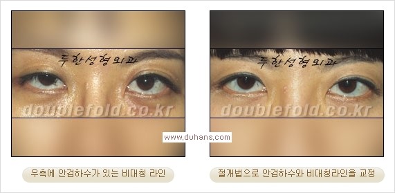[두한성형외과 경쟁력 맞춤 눈성형] - [눈성형에 관한 자주하는 질문과 답변 안내] 관련 이미지 14