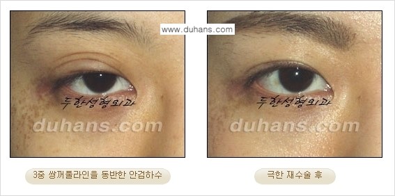 [두한성형외과 경쟁력 눈성형] - [두꺼운 라인을 교정하는 극한 눈 재수술 2.] 관련 이미지 5