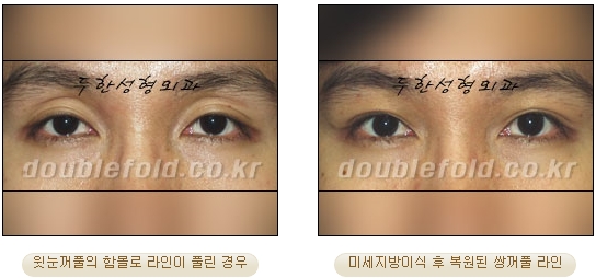 [두한성형외과 쌍커풀수술] - [눈성형 방법에 대한 자주하는 질문과 답변] 관련 이미지 103