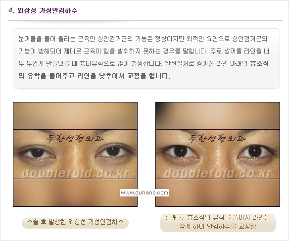 [두한성형외과 경쟁력 쌍꺼풀 재수술, 극한 눈재수술] - [안검하수 종류 안내] 관련 이미지 7