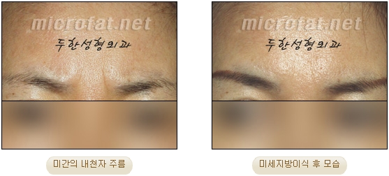 [두한성형외과 자가지방이식] - [미간주름] 관련 이미지 14