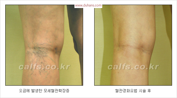 [두한성형외과 경쟁력 종아리성형 리더] - [종아리 성형 안내] 관련 이미지 19