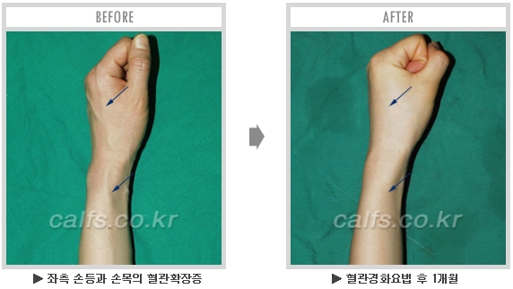 [종아리성형 두한성형외과] - [종아리수술에 대한 자주하는 질문과 답변 모음] 관련 이미지 45