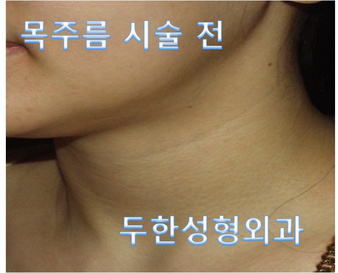 [두한성형외과 목주름]-[#목주름레이저 #목주름 #주름개선레이저 #주름교정] 관련 이미지 1
