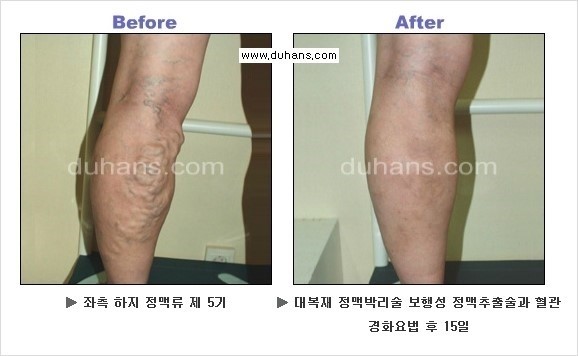 [두한성형외과 경쟁력 정맥류 치료] - [정맥류와 정맥확장증 증상과 합병증] 관련 이미지 8