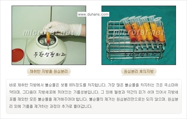 [두한성형외과 경쟁력 미세지방이식] - [미세지방이식을 이용한 코성형의 장점 안내] 관련 이미지 5