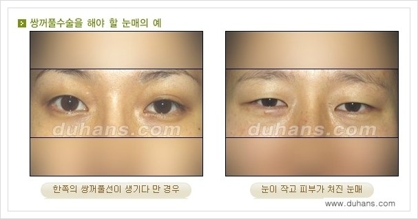 [두한성형외과 경쟁력 눈성형] - [아름다운 눈매를 쌍꺼풀수술 안내 ①] 관련 이미지 2