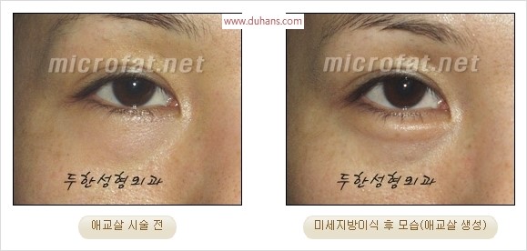 ​﻿[두한성형외과 경쟁력 지방이식] - [눈밑 애교살 시술을 위한 미세지방이식] 관련 이미지 25