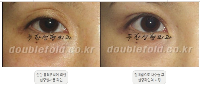 [Double Eyelid Surgery Duhan Plastic Surgery] - [Revision Methods] image 20
