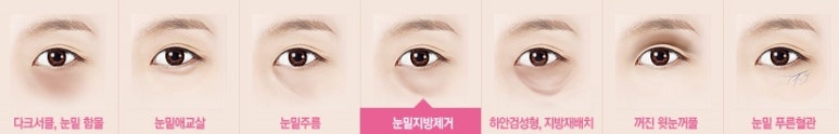 [두한성형외과 다크서클] - [다크서클 전후사진 검증] 관련 이미지 88