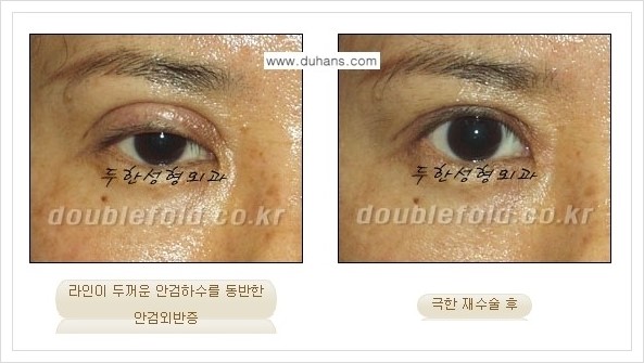 [두한성형외과 경쟁력 쌍꺼풀 재수술, 극한 재수술] - [망친 눈(쌍꺼풀) 복원수술과 일반 쌍꺼풀 재수술과의 차이점] 관련 이미지 13
