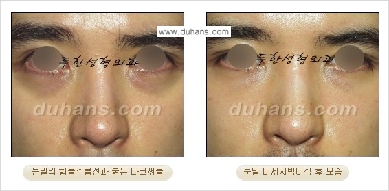 [두한성형외과 경쟁력 미세지방이식] - [다크써클 & 눈밑주름 미세지방이식 4.] 관련 이미지 6