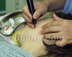 Duhan Plastic Surgery Laser Treatment - Mole Removal, Spot Removal, Melasma, Blemishes, Hyperpigmentation, Skin Tone Improvement, Elasticity Improvement, Skin Texture Improvement image 19