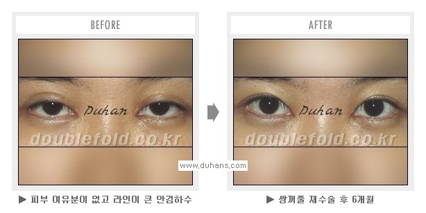 [두한성형외과 Dr. 컬럼] - [쌍꺼풀 재수술(눈 재수술)의 목적] 관련 이미지 2