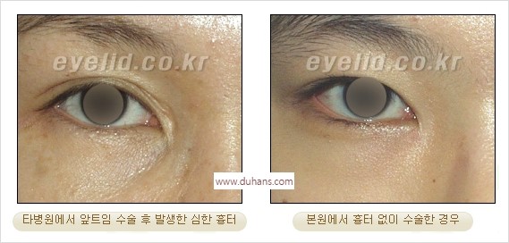 [두한성형외과 경쟁력 눈성형] - [흉터없는 몽고주름 제거 - 앞트임 수술] 관련 이미지 4
