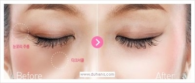 [두한성형외과 경쟁력 눈밑성형] - [다크써클 수술 동시 콤비 프로그램 안내] 관련 이미지 28