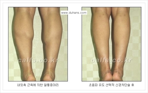 [두한성형외과 경쟁력 멀티종아리성형] - [나에게 맞는 종아리성형 방법의 종류 안내 2.] 관련 이미지 3