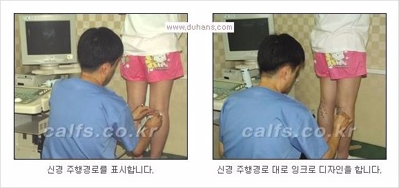 [두한성형외과 Dr. 컬럼 - 타 병원의 종아리 퇴축술 이후 문제가 발생한 경우] 관련 이미지 4
