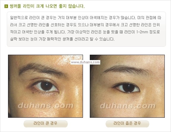 [두한성형외과 경쟁력 눈성형] - [눈성형, 쌍꺼풀 수술 방법에 관한 자주하는 질문과 답변 안내] 관련 이미지 1
