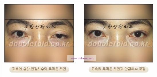 [두한성형외과 경쟁력 쌍꺼풀 재수술] - [비대칭 라인 교정(Correction of asymmetric fold line) 수술] 관련 이미지 1