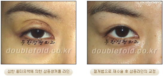 [두한성형외과 눈재수술] - [재수술 방법들] 관련 이미지 21