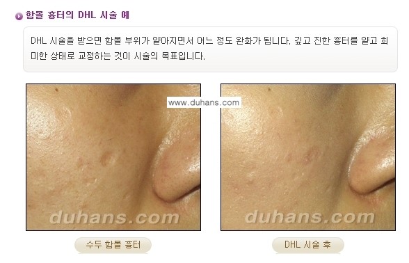 [두한성형외과 흉터 교정] - [함몰흉터의 DHC 시술] 관련 이미지 10