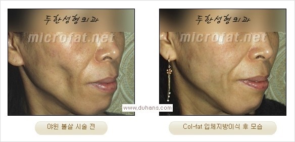 [두한성형외과 경쟁력 지방이식] - [두한 자가지방이식 클리닉 안내]​ 관련 이미지 43