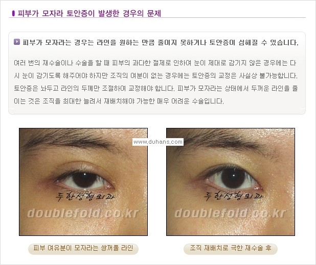 [두한성형외과 경쟁력 쌍꺼풀 재수술, 극한 재수술] - [쌍꺼풀 재수술, 극한 재수술 시 문제점 안내] 관련 이미지 6