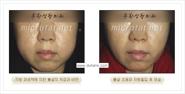 [두한성형외과 겨울엔 지방흡입을] - [볼살, 눈밑, 턱선의 초음파 미세지방흡입 1.] 관련 이미지 2