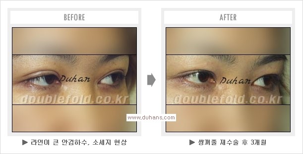 [두한성형외과 경쟁력 쌍꺼풀 재수술, 극한 눈재수술] - [두툼한 소세지 쌍꺼풀 라인 교정] 관련 이미지 15